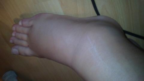 Zerrung Oder Schlimmer Sport Sprunggelenk