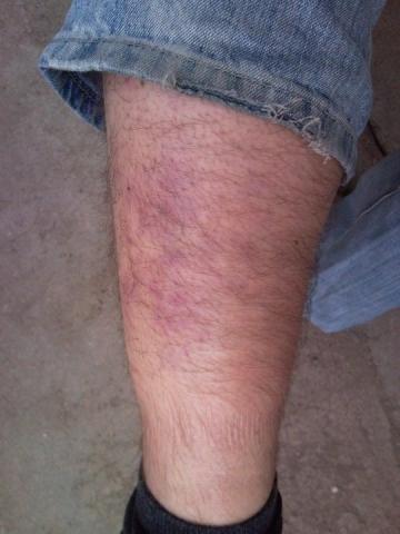 Schmerzen In Der Wade Nur Eine Prellung Muskelfaserriss