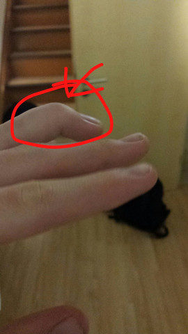 Kapselriss finger Finger ausgekugelt