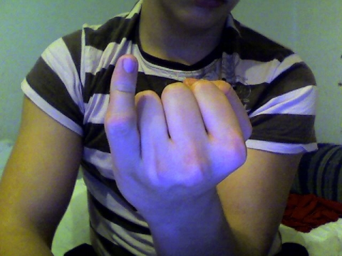 Finger Gebrochen Brauche Rat Finger Gebrochen Brauche Rat