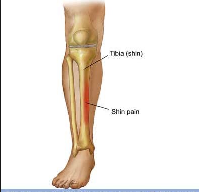 Knochenhautentzundung Will Nicht Weg Was Tun Fussball Schienbein Knochen Knochenhautentzundung Will Nicht Weg Was Tun Fussball Schienbein Knochen