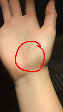 Nach Drauffallen auf die Hand beim Handball Schmerzen. Was könnte das sein?