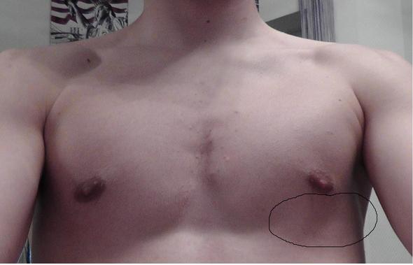 Rechte Brust Unten Keine Muskeln Aufbauen Rechte Brust Unten Keine Muskeln Aufbauen