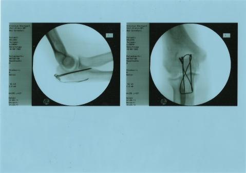 Wie sieht die Nachbehandlung 3 Wochen nach OP Olekranonfraktur mit